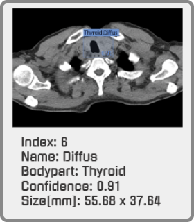 thyroid hover